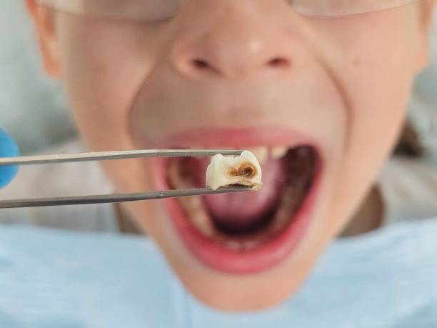 Best Broken or Cracked Tooth Emergency Dentist in Hazel Park, MI